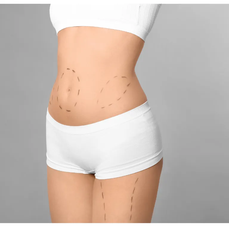 Gastric Bypass Surgery